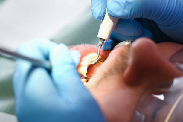 Best Emergency Tooth Extraction in Newberry, FL