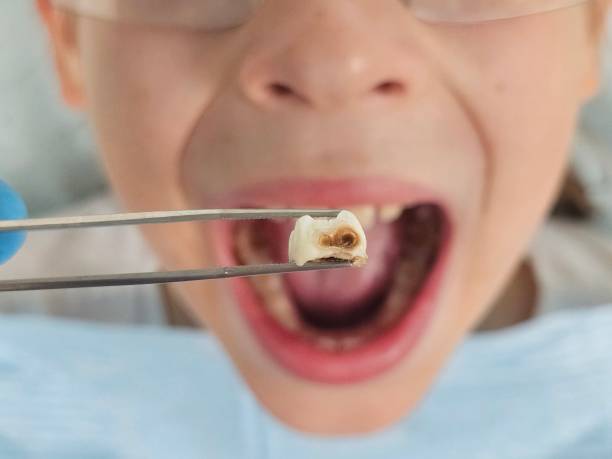 Best Emergency Dental Care for Broken or Chipped Teeth in Newberry, FL