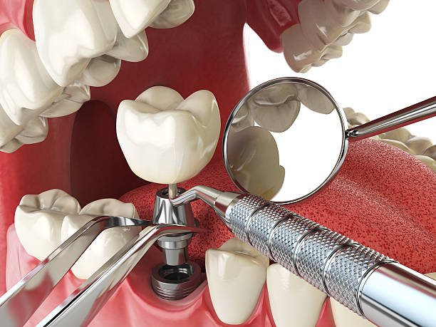 Best Emergency Denture Repair in Newberry, FL